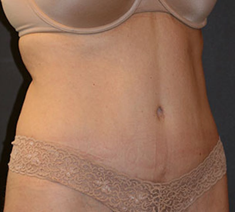 Abdominoplasty (Tummy Tuck) Before & After Gallery - Patient 106984745 - Image 4