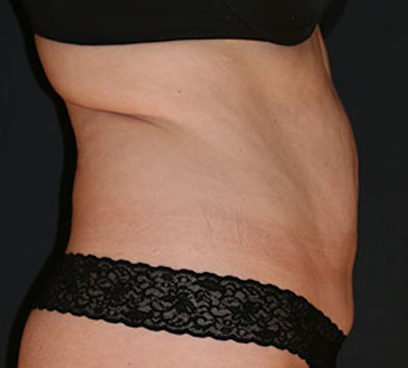 Abdominoplasty (Tummy Tuck) Before & After Gallery - Patient 106984745 - Image 5