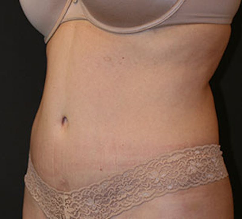 Abdominoplasty (Tummy Tuck) Before & After Gallery - Patient 106984745 - Image 8