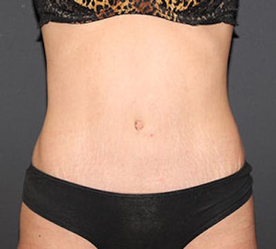 Abdominoplasty (Tummy Tuck) Before & After Gallery - Patient 106984762 - Image 2