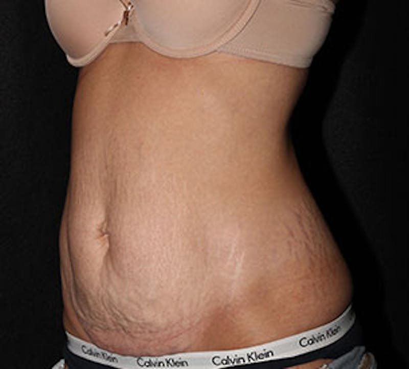 Abdominoplasty (Tummy Tuck) Before & After Gallery - Patient 106984762 - Image 7