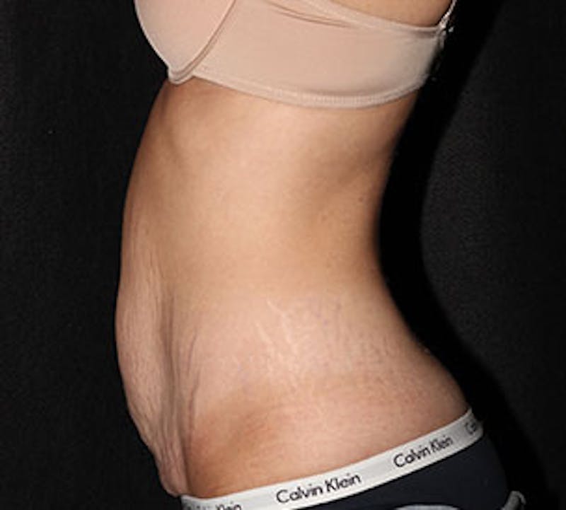 Abdominoplasty (Tummy Tuck) Before & After Gallery - Patient 106984762 - Image 9