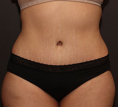 Abdominoplasty (Tummy Tuck) Before & After Gallery - Patient 106984770 - Image 2