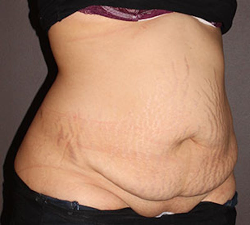 Abdominoplasty (Tummy Tuck) Before & After Gallery - Patient 106984770 - Image 3