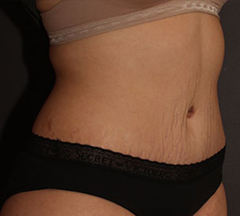Abdominoplasty (Tummy Tuck) Before & After Gallery - Patient 106984770 - Image 4