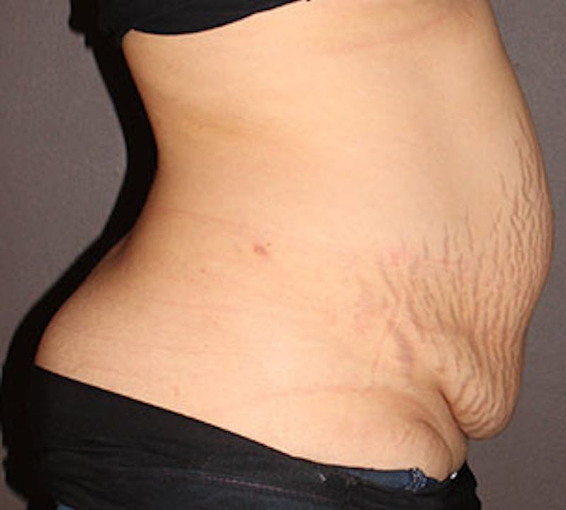 Abdominoplasty (Tummy Tuck) Before & After Gallery - Patient 106984770 - Image 5