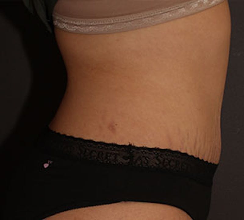 Abdominoplasty (Tummy Tuck) Before & After Gallery - Patient 106984770 - Image 6