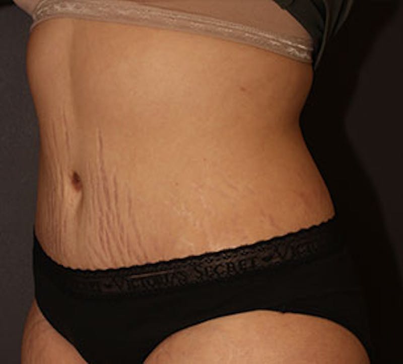Abdominoplasty (Tummy Tuck) Before & After Gallery - Patient 106984770 - Image 8