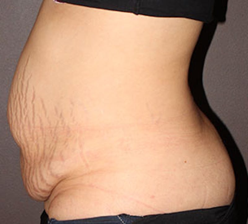 Abdominoplasty (Tummy Tuck) Before & After Gallery - Patient 106984770 - Image 9