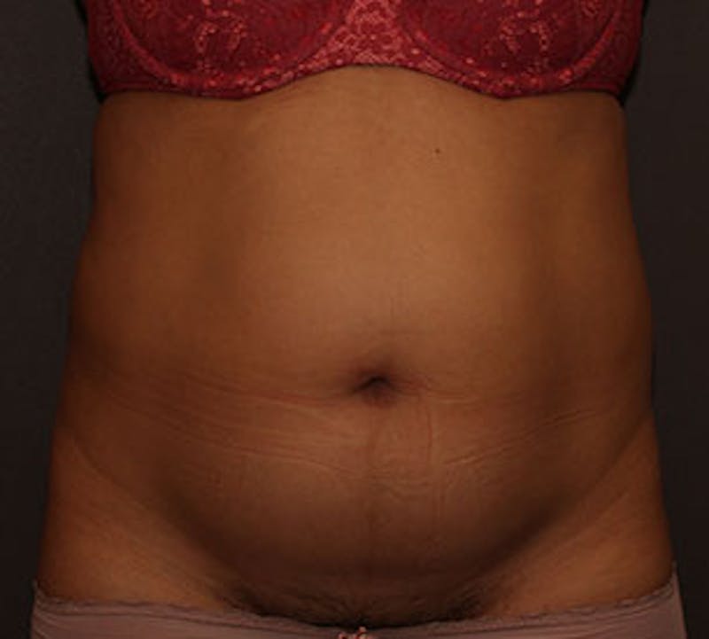 Abdominoplasty (Tummy Tuck) Gallery - Patient 106984773 - Image 1