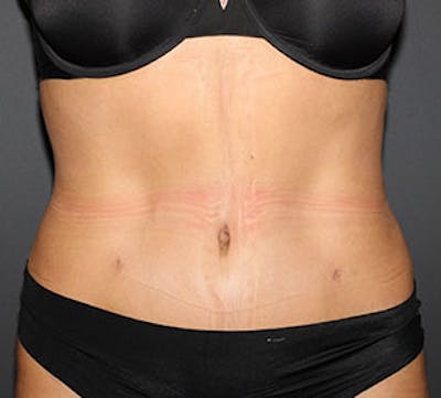 Abdominoplasty (Tummy Tuck) Before & After Gallery - Patient 106984773 - Image 2