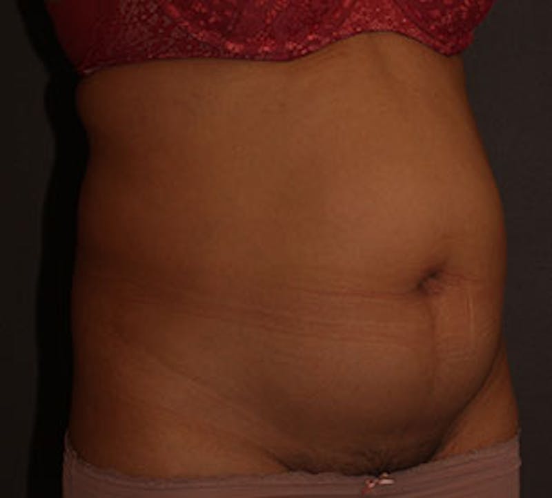 Abdominoplasty (Tummy Tuck) Before & After Gallery - Patient 106984773 - Image 3