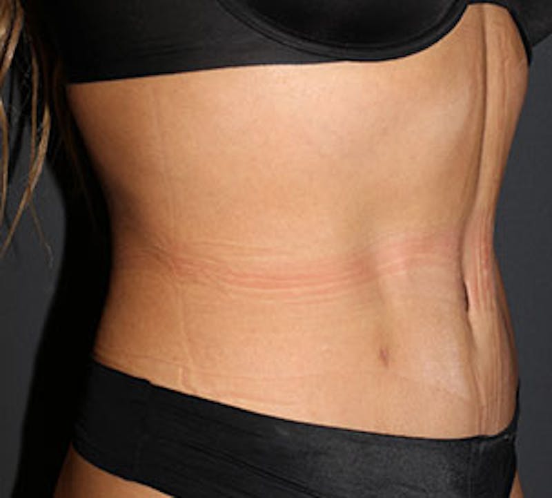 Abdominoplasty (Tummy Tuck) Before & After Gallery - Patient 106984773 - Image 4