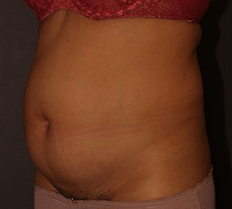 Abdominoplasty (Tummy Tuck) Before & After Gallery - Patient 106984773 - Image 7