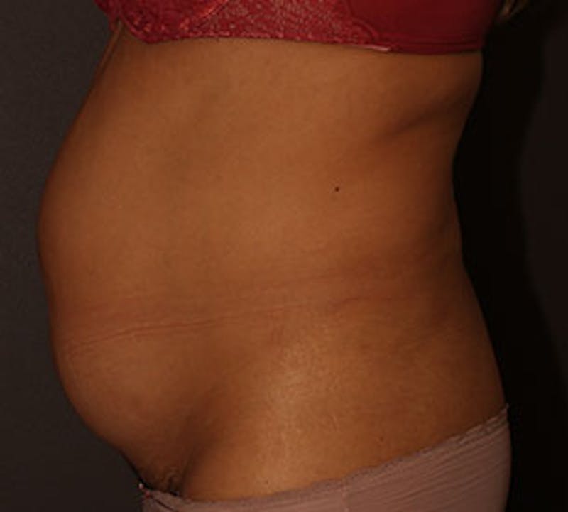 Abdominoplasty (Tummy Tuck) Before & After Gallery - Patient 106984773 - Image 9
