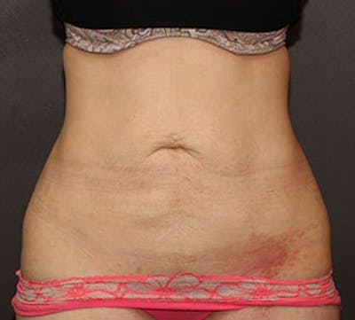 Abdominoplasty (Tummy Tuck) Before & After Gallery - Patient 106984781 - Image 1