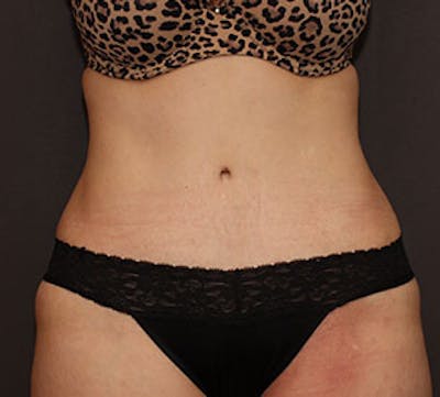 Abdominoplasty (Tummy Tuck) Before & After Gallery - Patient 106984781 - Image 2