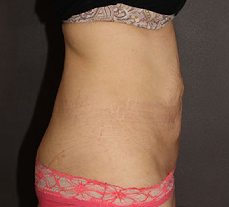 Abdominoplasty (Tummy Tuck) Before & After Gallery - Patient 106984781 - Image 5
