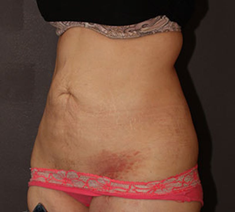 Abdominoplasty (Tummy Tuck) Gallery - Patient 106984781 - Image 7