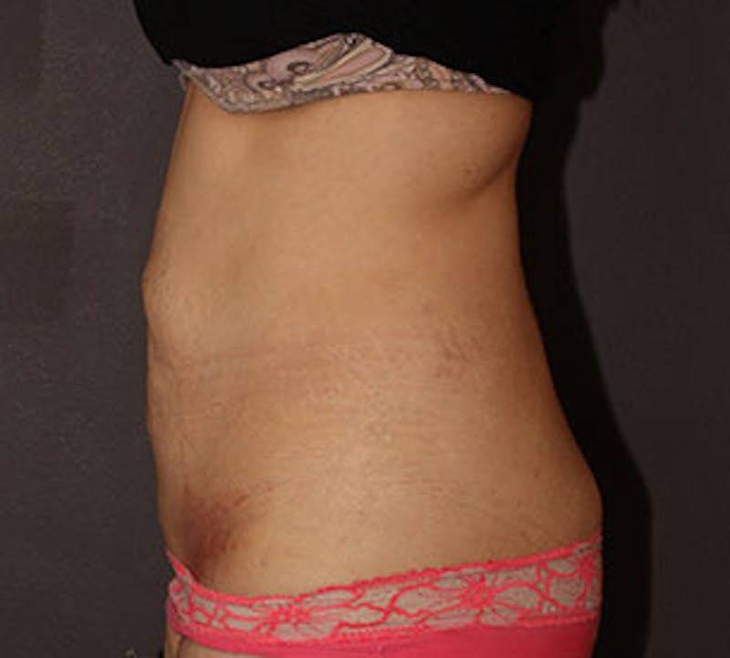 Abdominoplasty (Tummy Tuck) Before & After Gallery - Patient 106984781 - Image 9