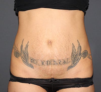Abdominoplasty (Tummy Tuck) Before & After Gallery - Patient 106984790 - Image 1