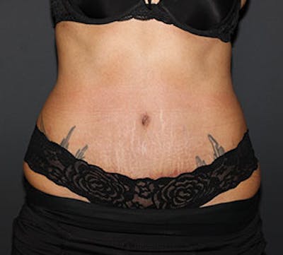 Abdominoplasty (Tummy Tuck) Before & After Gallery - Patient 106984790 - Image 2