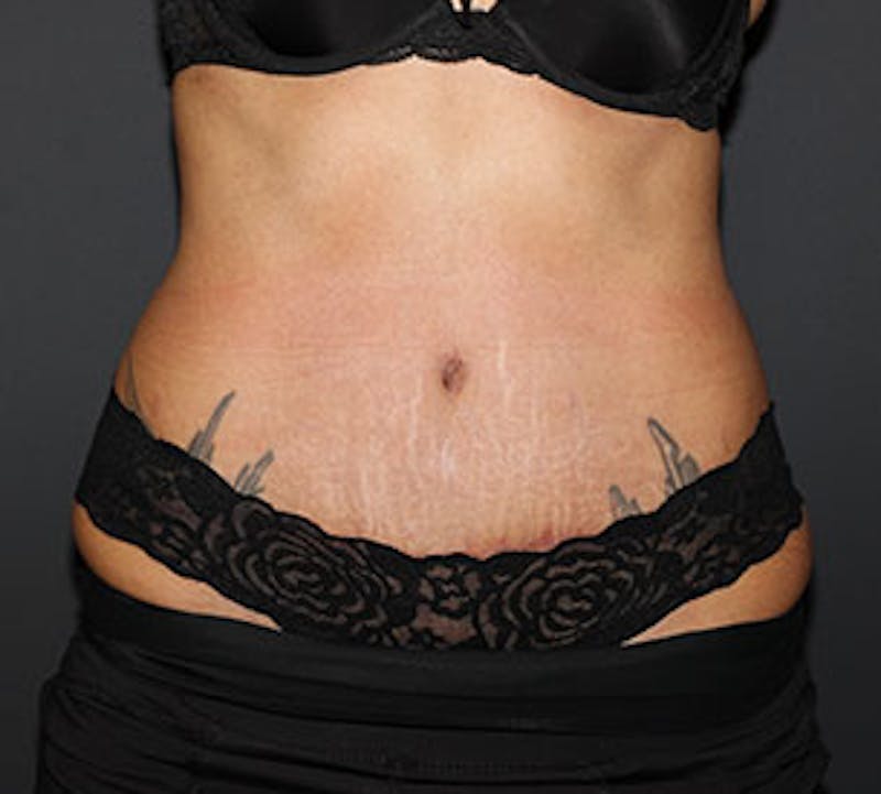 Abdominoplasty (Tummy Tuck) Before & After Gallery - Patient 106984790 - Image 2