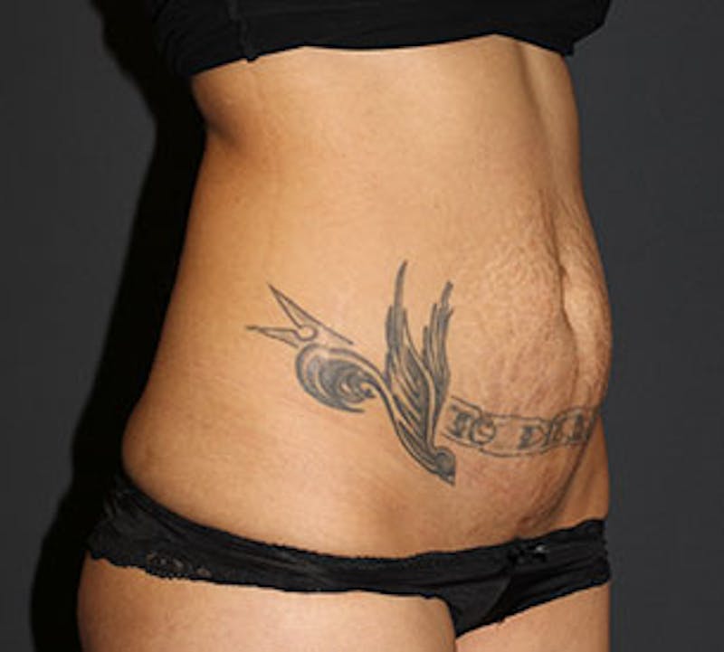 Abdominoplasty (Tummy Tuck) Before & After Gallery - Patient 106984790 - Image 3