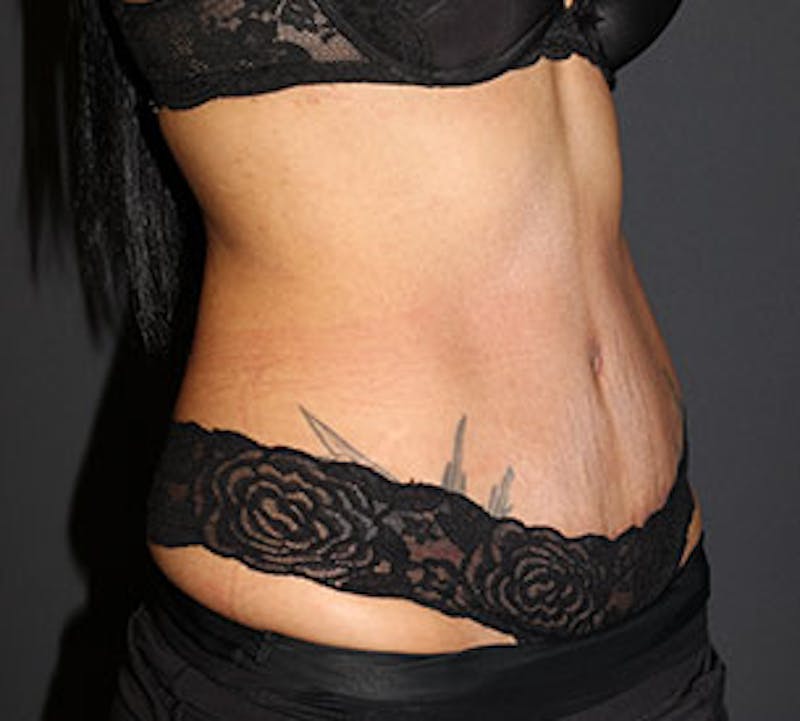 Abdominoplasty (Tummy Tuck) Before & After Gallery - Patient 106984790 - Image 4
