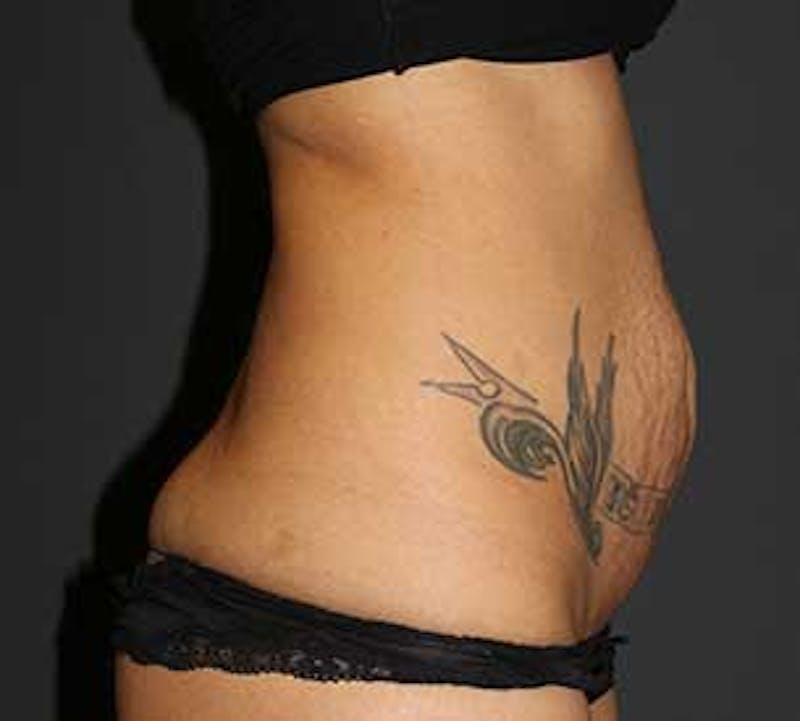 Abdominoplasty (Tummy Tuck) Before & After Gallery - Patient 106984790 - Image 5