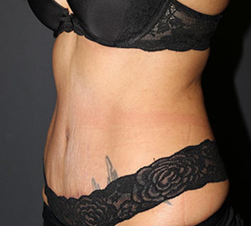 Abdominoplasty (Tummy Tuck) Before & After Gallery - Patient 106984790 - Image 8
