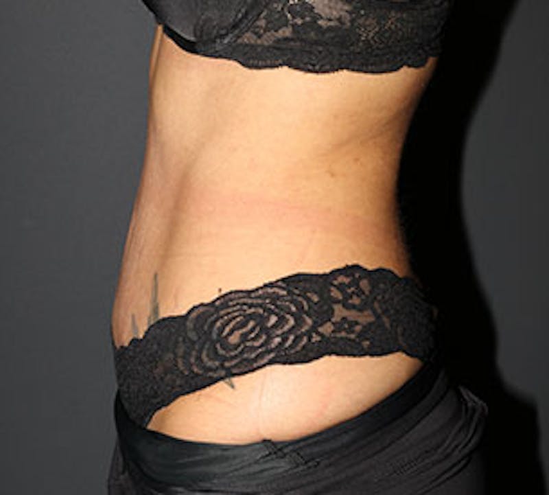 Abdominoplasty (Tummy Tuck) Before & After Gallery - Patient 106984790 - Image 10