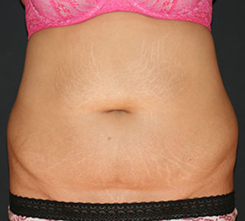 Abdominoplasty (Tummy Tuck) Before & After Gallery - Patient 106984800 - Image 1