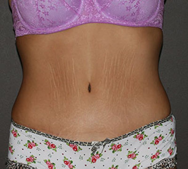 Abdominoplasty (Tummy Tuck) Before & After Gallery - Patient 106984800 - Image 2