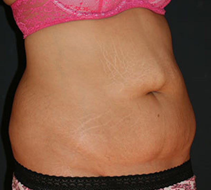 Abdominoplasty (Tummy Tuck) Before & After Gallery - Patient 106984800 - Image 3