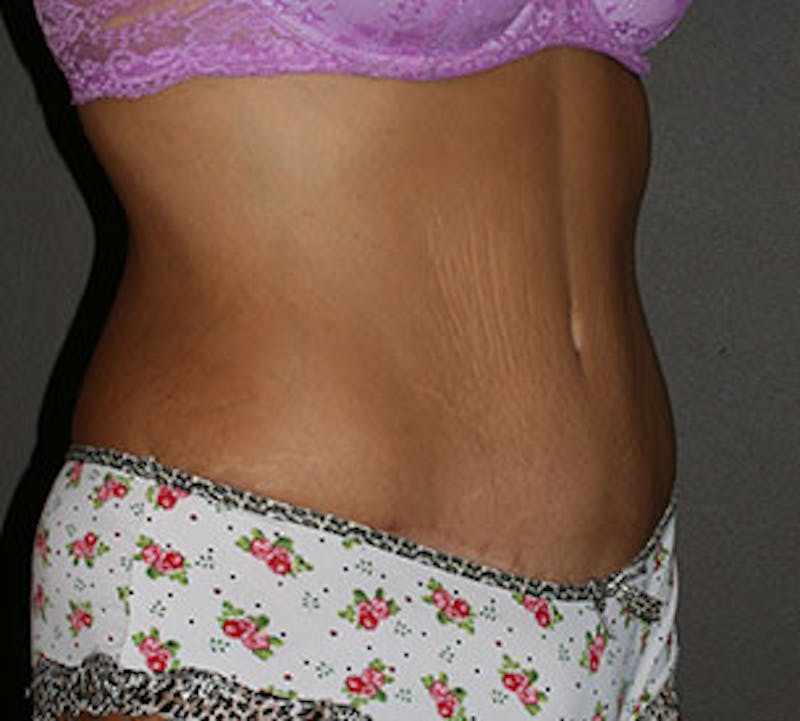 Abdominoplasty (Tummy Tuck) Before & After Gallery - Patient 106984800 - Image 4