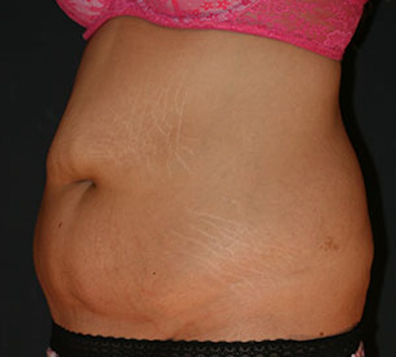 Abdominoplasty (Tummy Tuck) Before & After Gallery - Patient 106984800 - Image 5