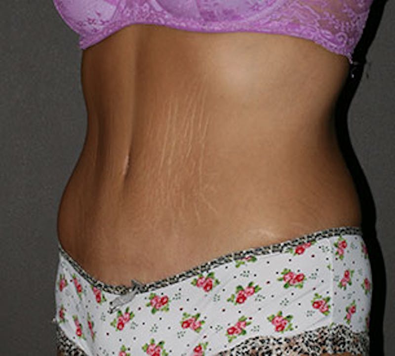 Abdominoplasty (Tummy Tuck) Before & After Gallery - Patient 106984800 - Image 6