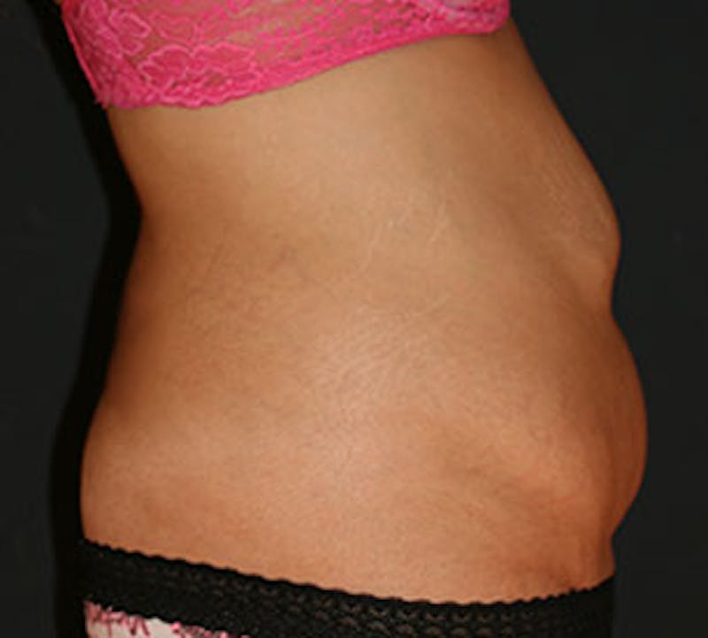 Abdominoplasty (Tummy Tuck) Before & After Gallery - Patient 106984800 - Image 7