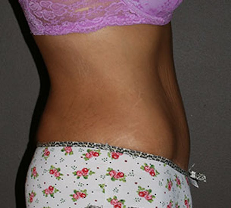 Abdominoplasty (Tummy Tuck) Before & After Gallery - Patient 106984800 - Image 8