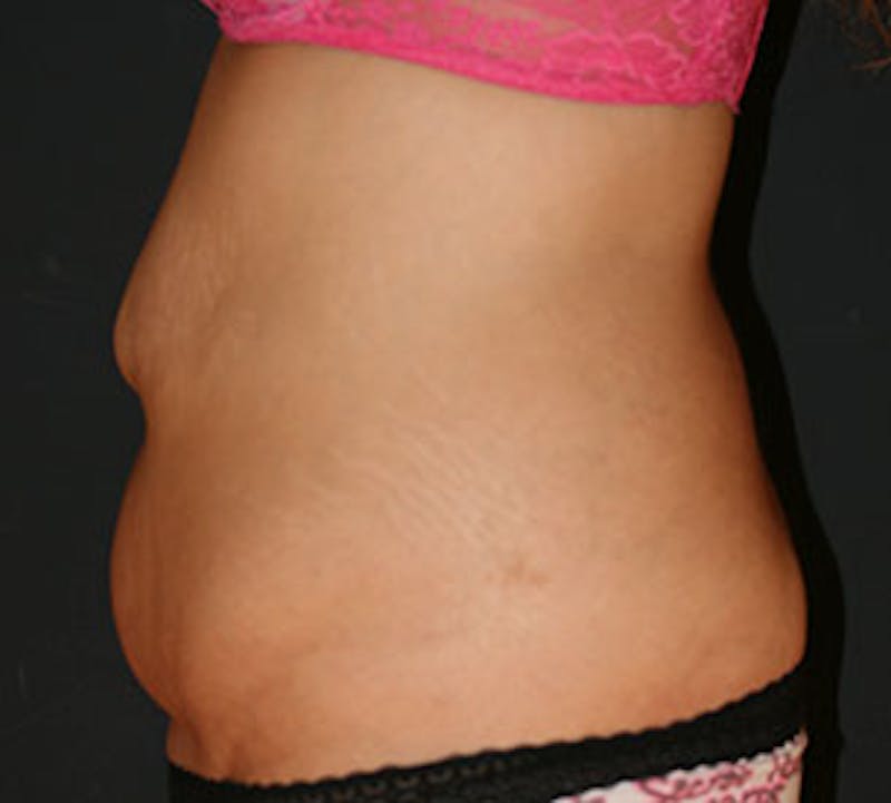 Abdominoplasty (Tummy Tuck) Before & After Gallery - Patient 106984800 - Image 9