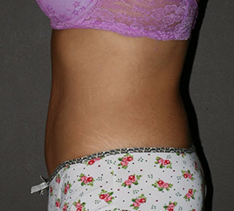 Abdominoplasty (Tummy Tuck) Before & After Gallery - Patient 106984800 - Image 10