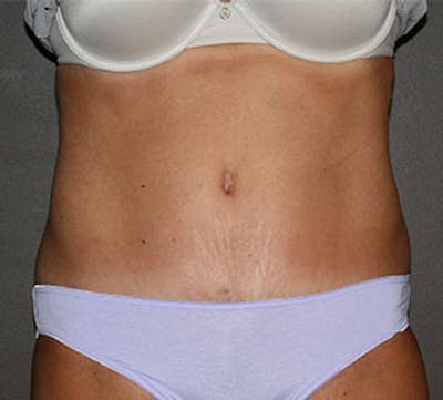 Abdominoplasty (Tummy Tuck) Before & After Gallery - Patient 106984805 - Image 2