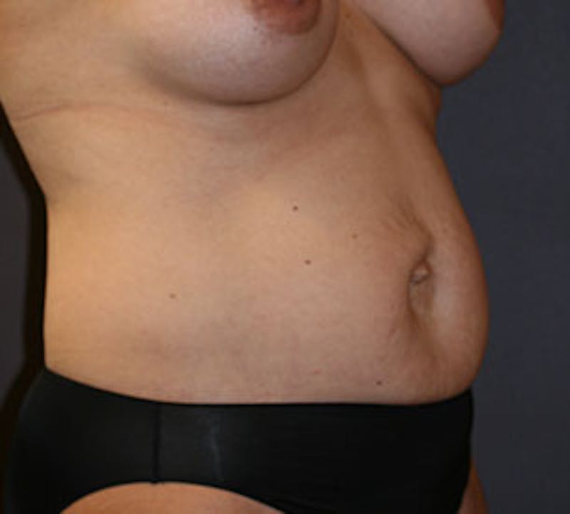 Abdominoplasty (Tummy Tuck) Gallery - Patient 106984805 - Image 3