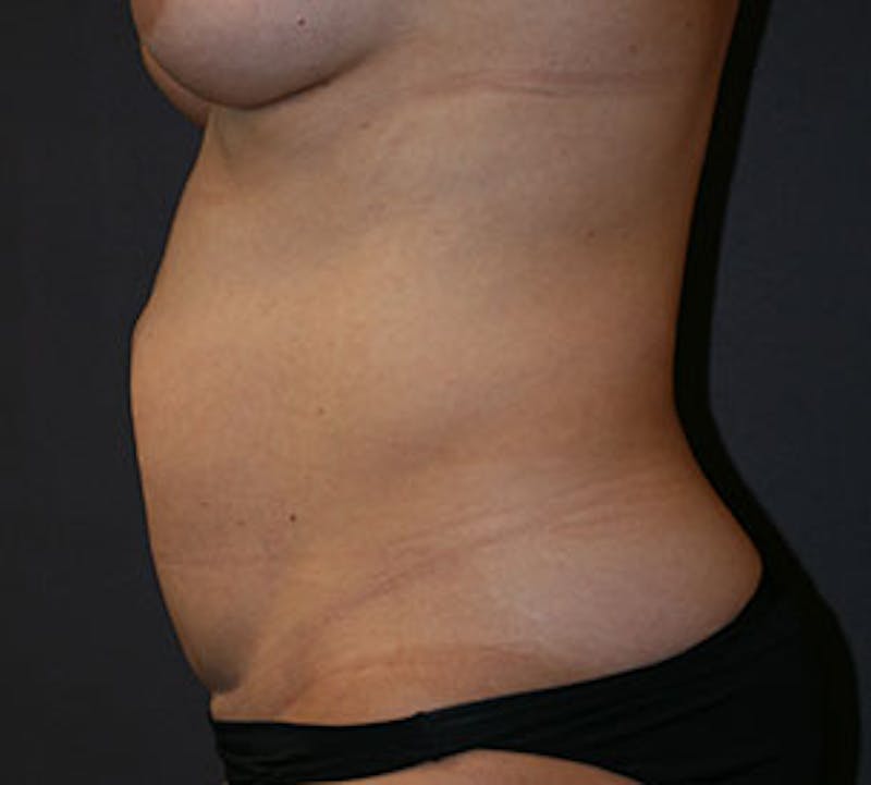 Abdominoplasty (Tummy Tuck) Before & After Gallery - Patient 106984805 - Image 9