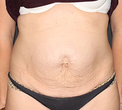 Abdominoplasty (Tummy Tuck) Before & After Gallery - Patient 106984811 - Image 1