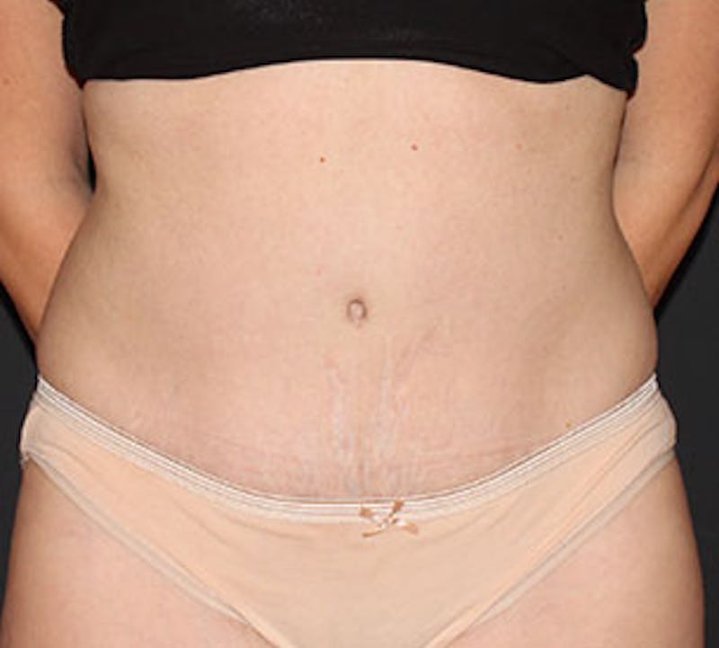 Abdominoplasty (Tummy Tuck) Before & After Gallery - Patient 106984811 - Image 2