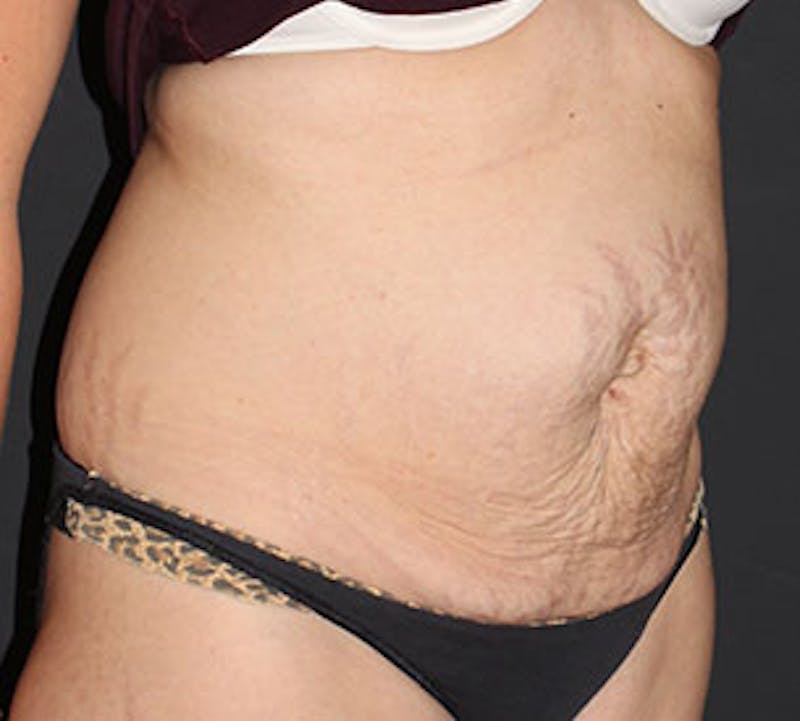 Abdominoplasty (Tummy Tuck) Before & After Gallery - Patient 106984811 - Image 3