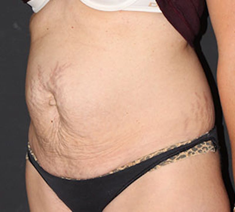 Abdominoplasty (Tummy Tuck) Before & After Gallery - Patient 106984811 - Image 5