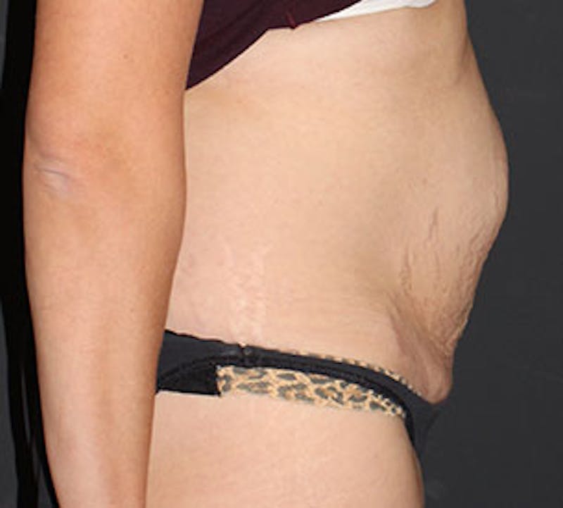 Abdominoplasty (Tummy Tuck) Before & After Gallery - Patient 106984811 - Image 7